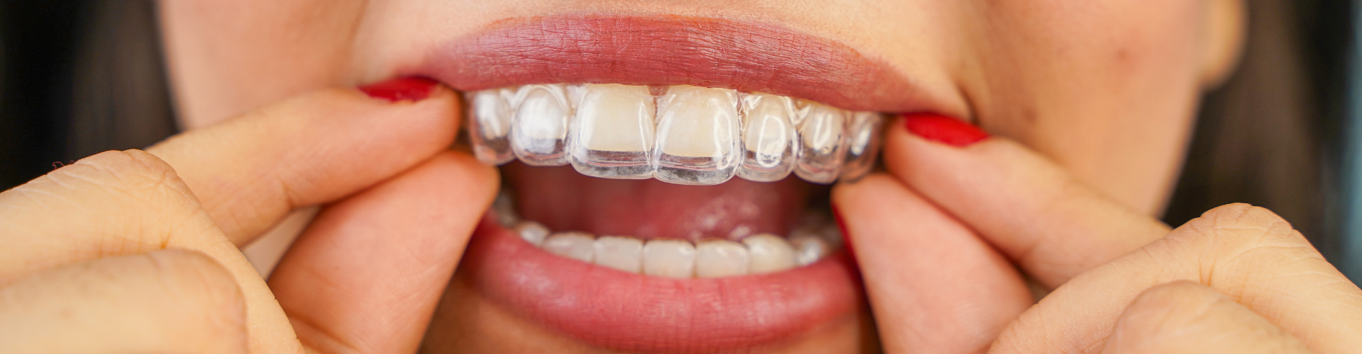 Woman placing clear aligner on upper teeth.